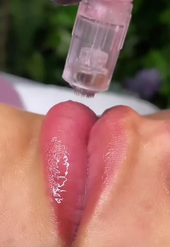 Microagujas: Hidratación de labios