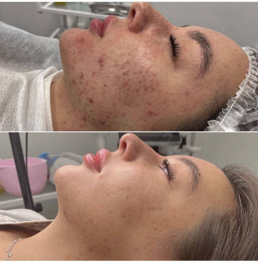 Facial Anti Acné