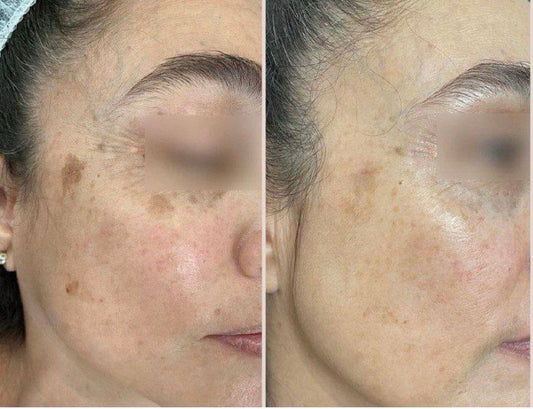 Peeling para manchas y pigmentación