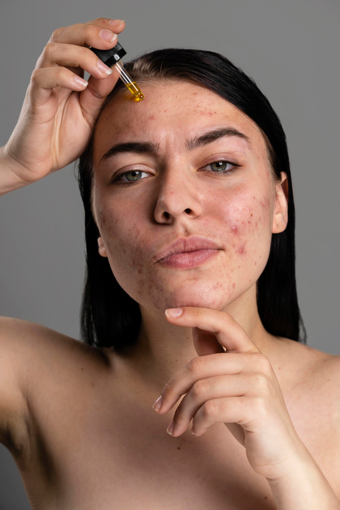 Peeling para acné y control de Grasa